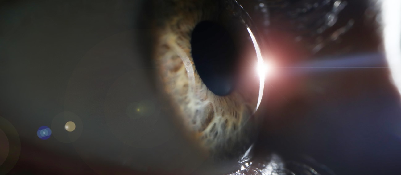 Eksfolyasyon Sendromu ve CYP39A1 Varyantı İlişkisi